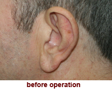 plastic-surgery-prominent-ear 